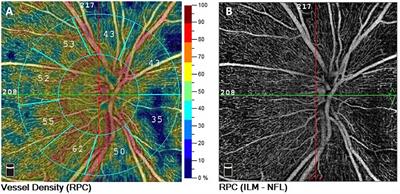Neurovascular retinal impairment in early-treated adults with phenylketonuria